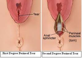 Perineum Tear During Intercourse: Causes and Treatments ...